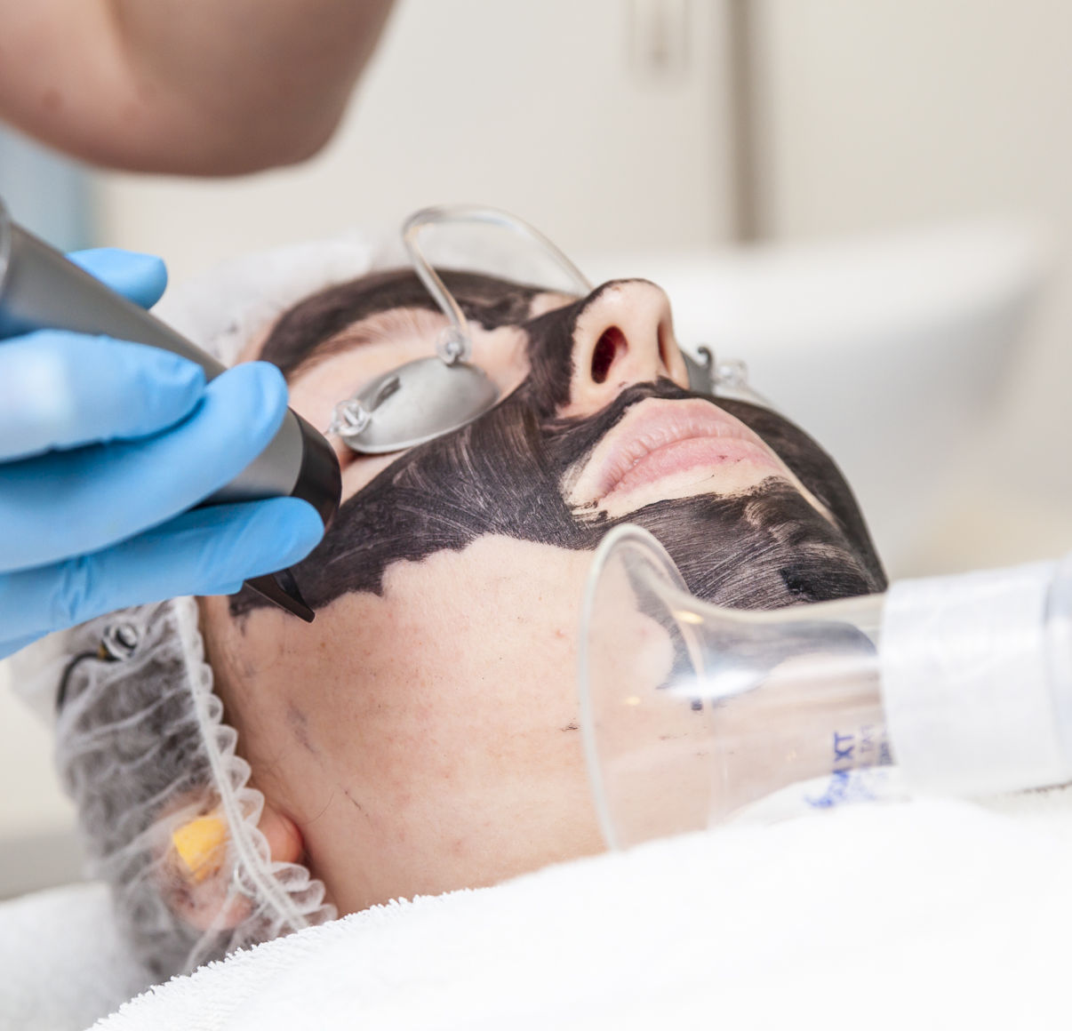Alma-Q Carbon Peel Alma-Q Carbon Peel
