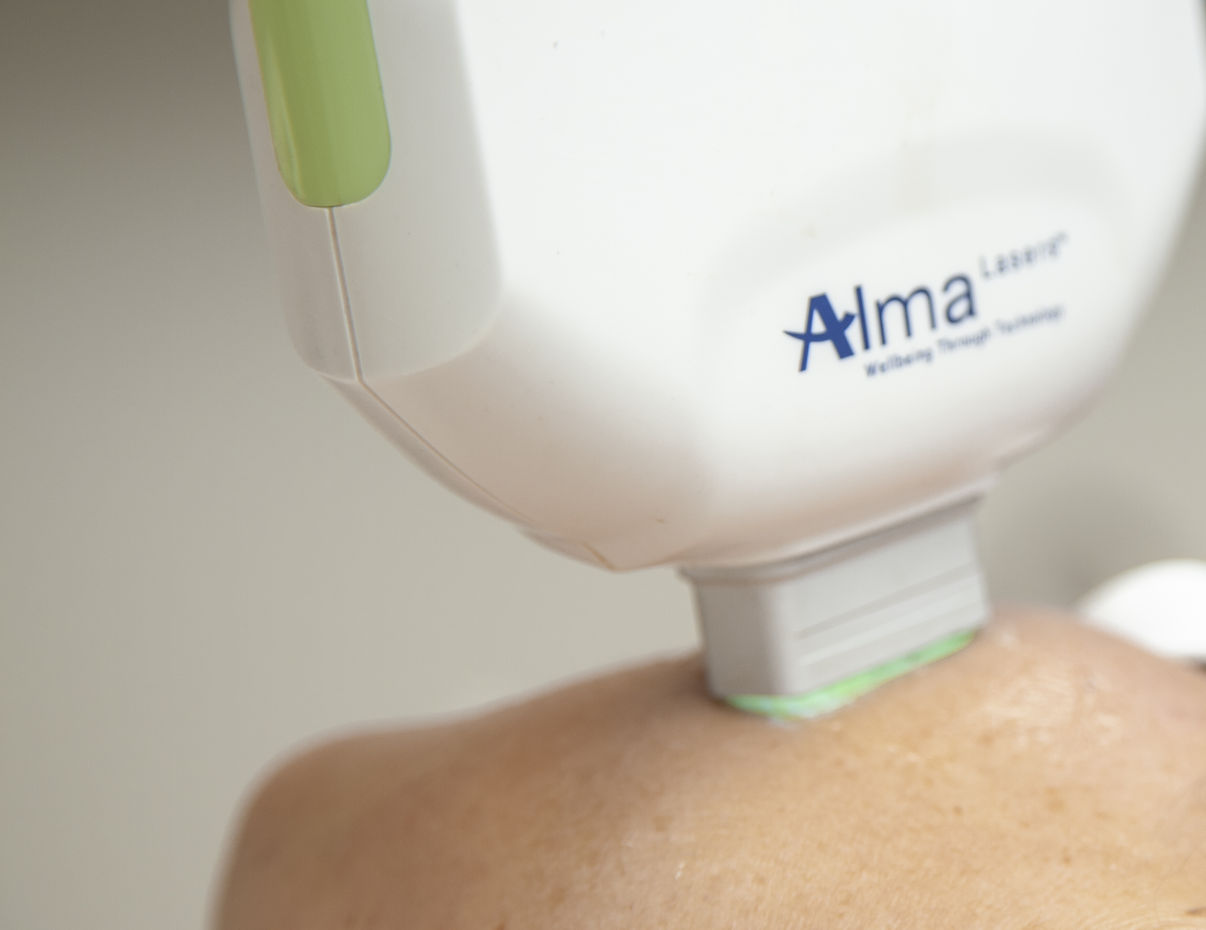 Behandelen pigmentstoornissen met de Alma laser