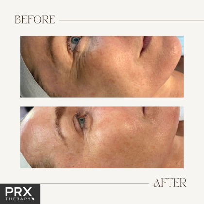 PRX-T33 Peeling before en after