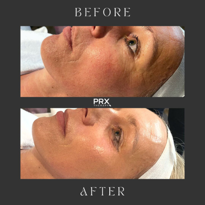 PRX-T33 Peeling before en after