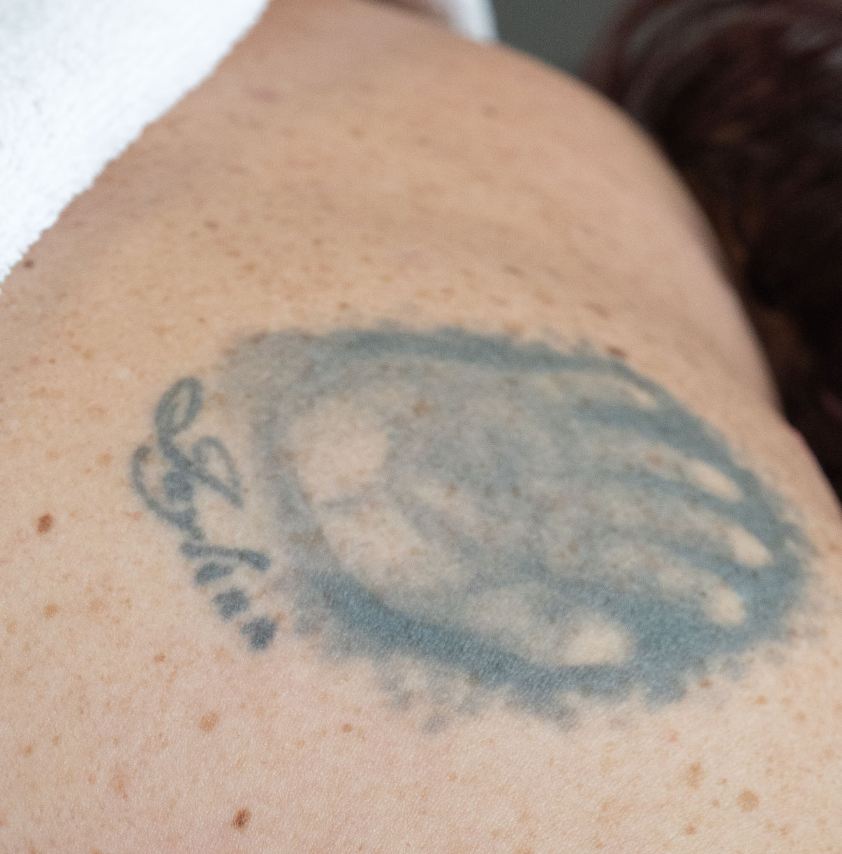 Tatoeage weghalen met laser