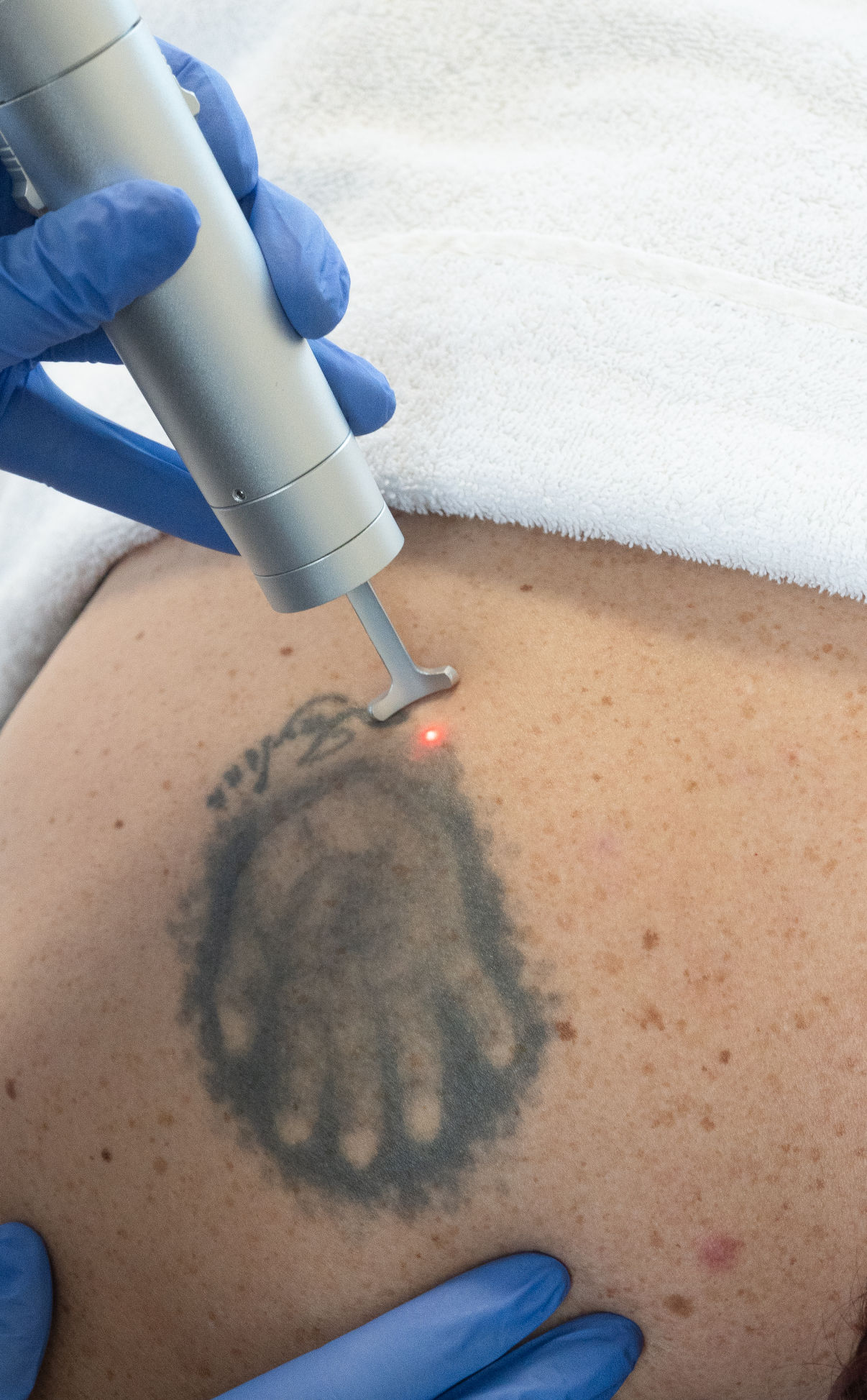 Tattoo verwijderen met laser Tattoo verwijderen met laser