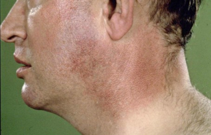 Zonnehals / Poikiloderma van Civatte